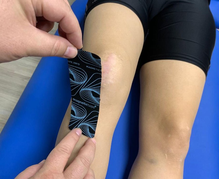 Skin cross-section showing magnetic field interaction with epidermal nerve fibers